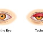 WHO validates Timor-Leste’s elimination of trachoma as a public health problem